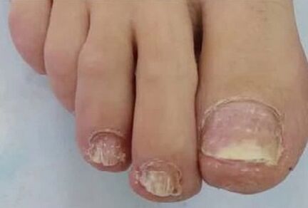 Nails were very touched by fungi