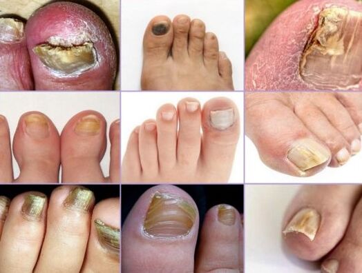 Damage to nails in different types of fungi