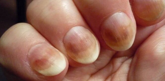 Mycosis