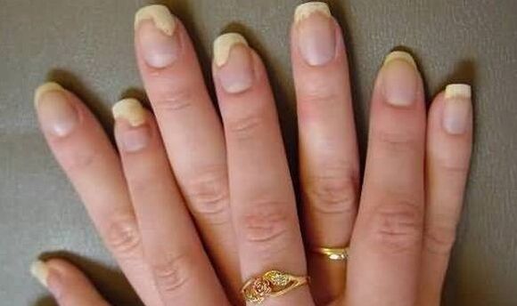 This is what the nail fungus looks like in the phase of irritation