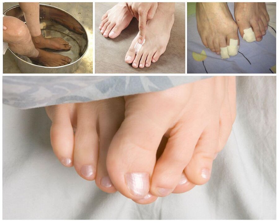 Treatment of fungi