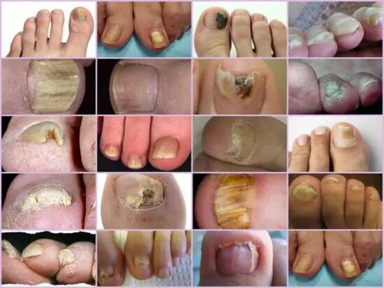 Onycomycosis of different localization in the nail