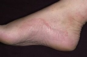 Damage to the fungus in the legs