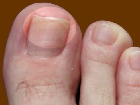 Fungal lesion