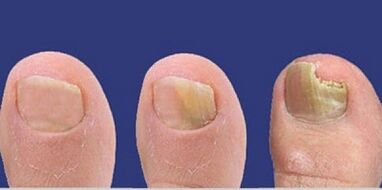 Stages of nail fungus development